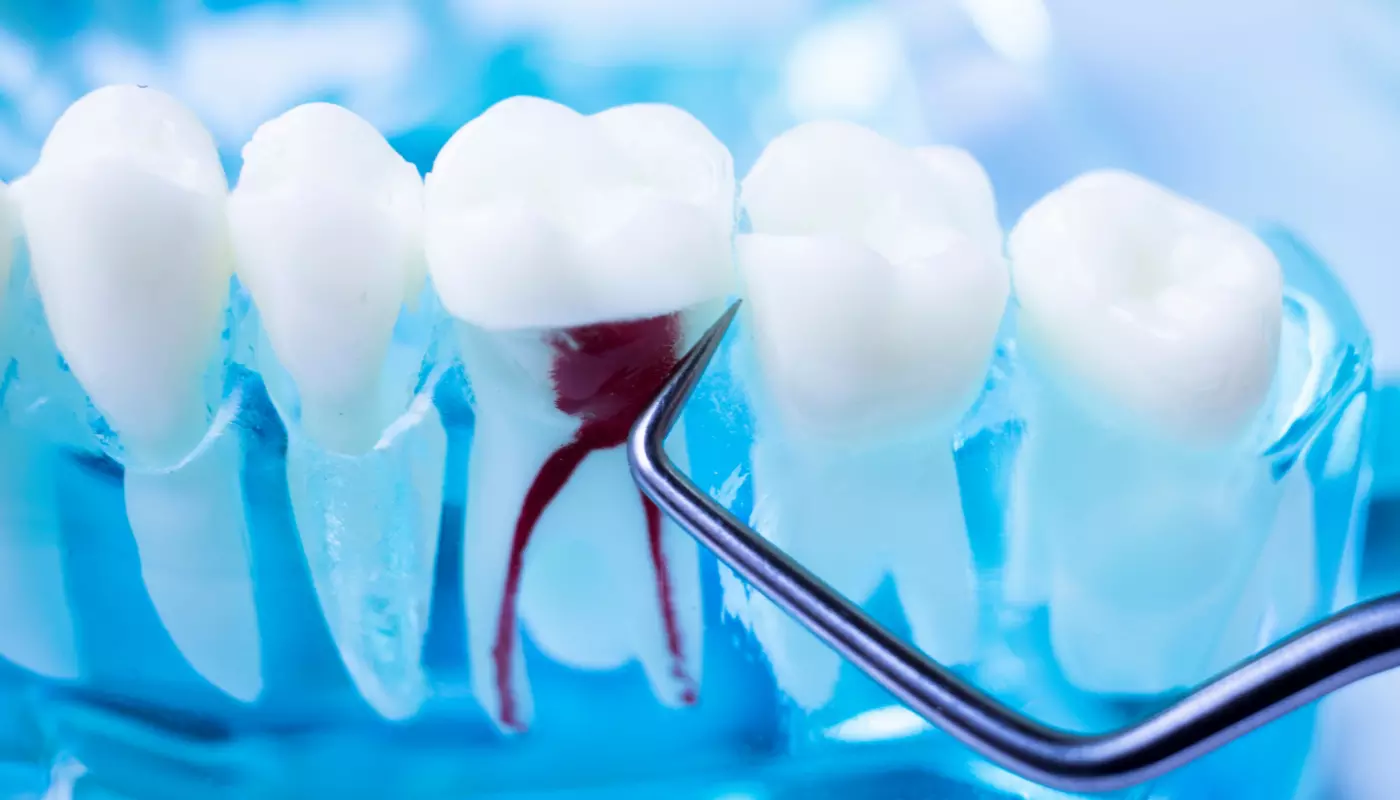 一般歯科(根管治療)
