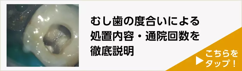 むし歯治療