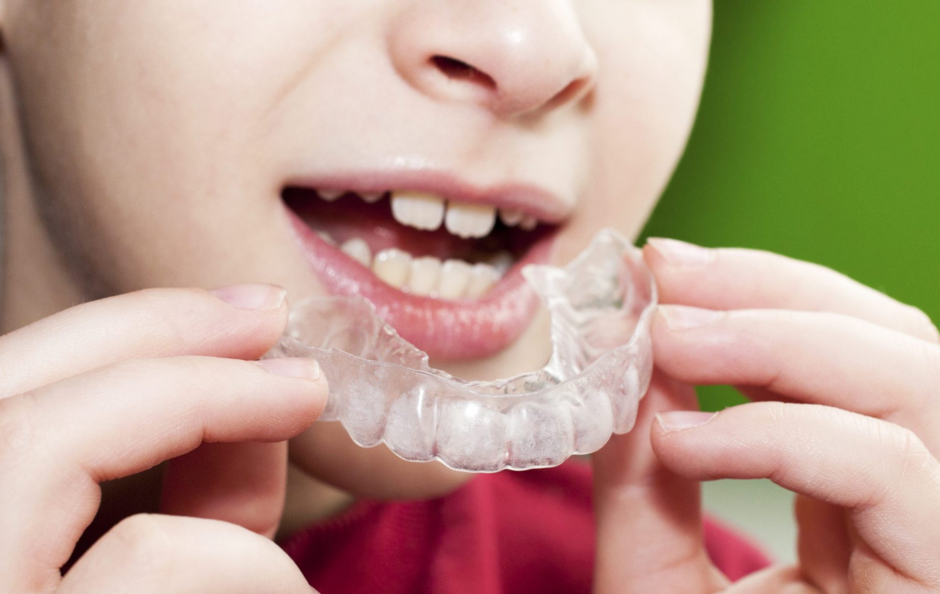 マウスピース矯正で子供の歯並びは治る？失敗しないコツとメーカーの