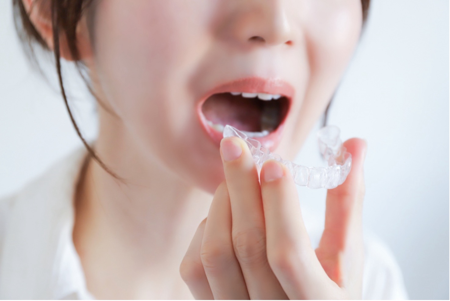 歯列矯正で失敗しないために！よくある事例と後悔しないための対策